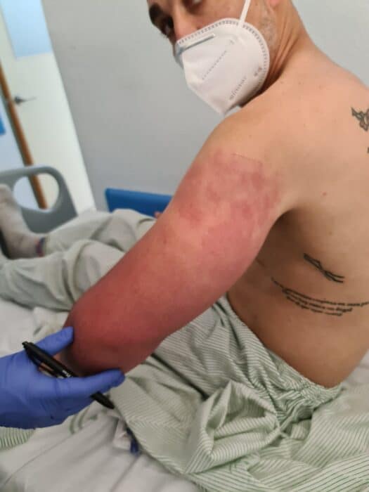 Tratamiento celulitis infecciosa braso. Descuento IATI seguros de viaje